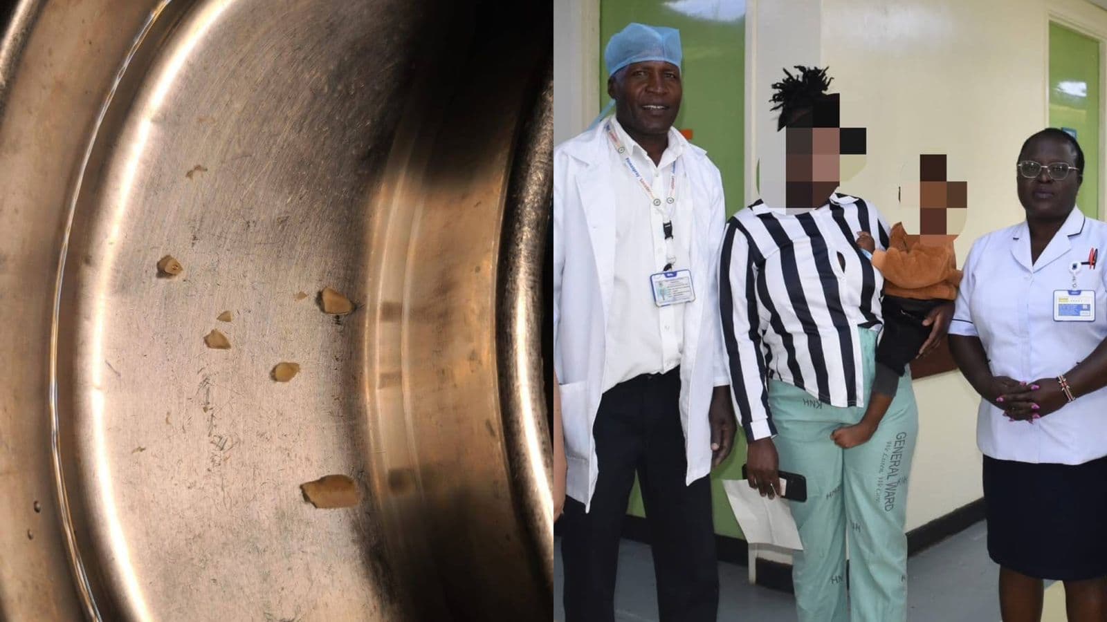 The Miracle at KNH: Surgeons Save 2-Year-Old After Peanut Lodges in Lung