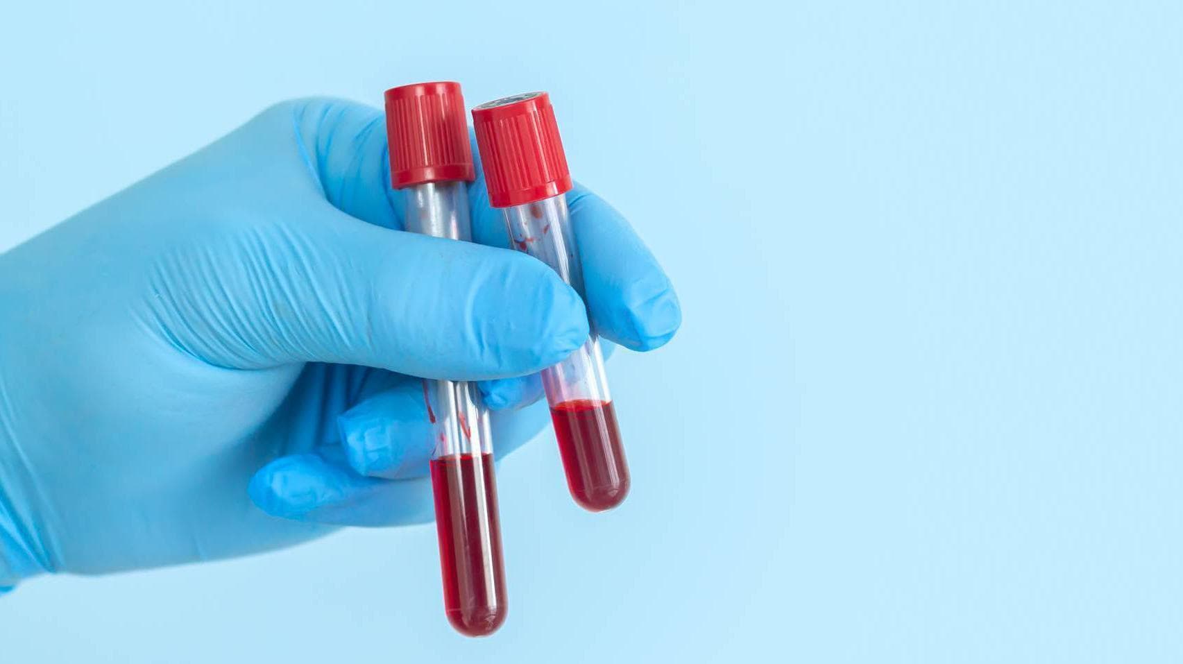 New Blood Test Offers Hope for Early Cancer Detection in Kenya
